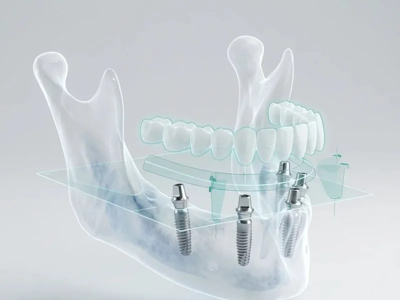 Caso complejo · 3D