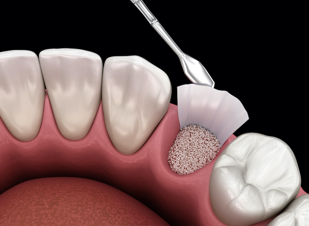 augmentation surgery adding bone after tooth extraction. 3d illustration