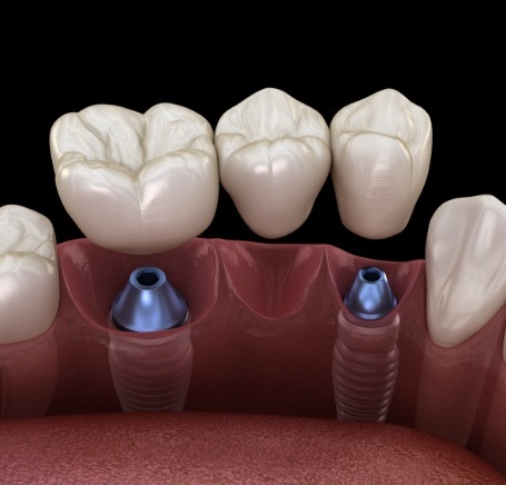 dental implants 6